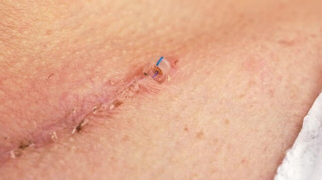Scar on the neck from surgery. Thyroidectomy.