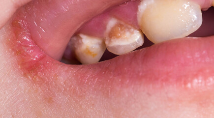 Obraz premium Insufficient hygiene of children's primary teeth. Destruction of enamel and development of caries, close-up