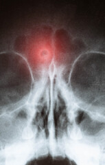 X-ray of sinusitis in a child. Inflammation of the nasal sinuses with purulent sinusitis, close-up