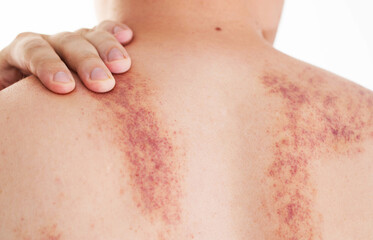 Redness and irritation on the skin of a man s back after a massage. Pimples and red spots with bruises on the skin, close-up