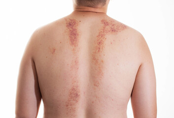 Redness and irritation on the skin of a man s back after a massage. Pimples and red spots with...