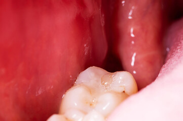 Obraz premium recess after complex impacted wisdom tooth extraction, traumatic healing. Dry socket, alveolitis, macro. Copy space for text