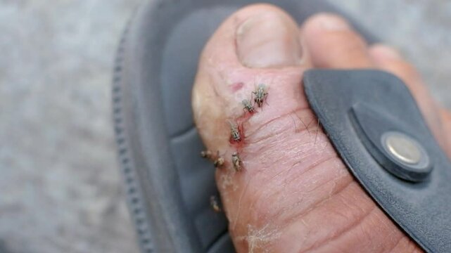 The wound on the big toe of a diabetic is being surrounded by flies