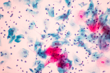 View in microscopic of Candidiasis, fungus infection (Yeast and Pseudohyphae form) in pap smear...