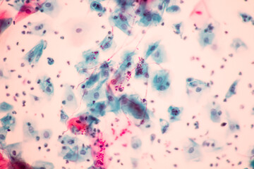 View in microscopic of Candidiasis, fungus infection (Yeast and Pseudohyphae form) in pap smear...