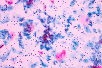 View in microscopic of Candidiasis, fungus infection (Yeast and Pseudohyphae form) in pap smear slide cytology and diagnostic by pathologist.Gynecology report and diagnosis.Sexually transmitted infect
