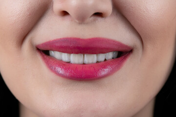 Fototapeta premium ceramic veneers b1 color