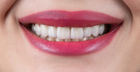 ceramic veneers b1 color