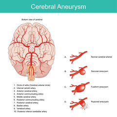Cerebral Aneurysm. A bulging artery weakened area in the wall of an artery in the brain.the artery wall will burst and open blood fill out.