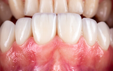 ceramic veneers b1 color