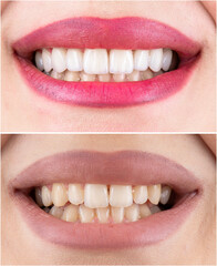 before and after picture of dental treatment by ceramic veneers