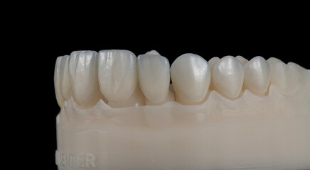 ceramic veneers b1 color
