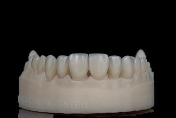 ceramic veneers b1 color