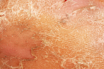 Fragment of cracked skin from a female heel