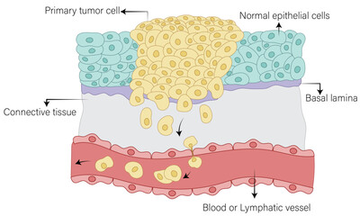 Formation of Secondary Tumor: Vector Illustration Depicting Metastasis Process, Cancer Cell Spread, and Tumor Growth for Medical and Educational Purposes