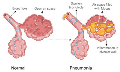 Detailed Pathology of Pneumonia: Comparing Airspace Filled with Mucus to Normal Lung Condition in a Comprehensive Illustration