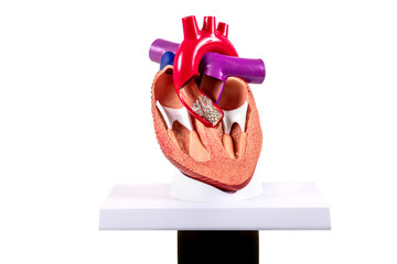 Cardiac model of Transcatheter aortic valve implantation (TAVI) for people education. Heart...