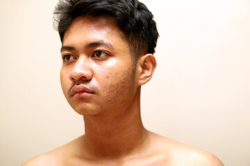 Fototapeta premium asian boy face full of pimples on cheeks, skin health concept due to hormones, allergies and sensitive skin.