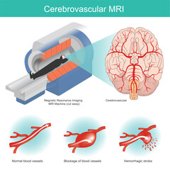 MRI cerebrovascular. special machine cerebral imaging is useful for the assessment of a wide range of cerebrovascular diseases.