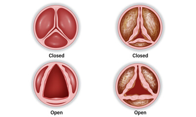 Aortic Valve Stenosis vector Illustration: Healthy vs. Stenotic Valve in Open and Closed Stages, Showing Calcification and Restricted Blood Flow