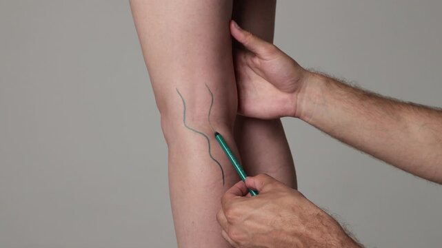 DVT. Woman is healing from deep vein thrombosis. 4k video surgeon is drawing lines on leg veins to assist in finding them during surgery.