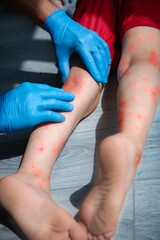 atopic dermatitis on the legs of a child