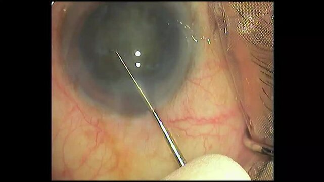 footage of Phacoemulsification Cataract surgery for the human eye 