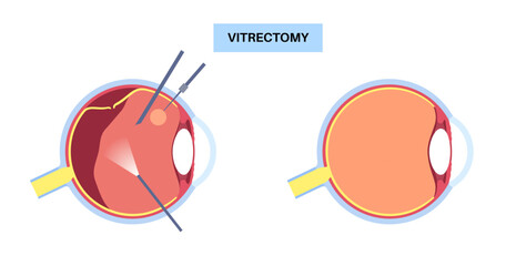 Vitrectomy surgical poster