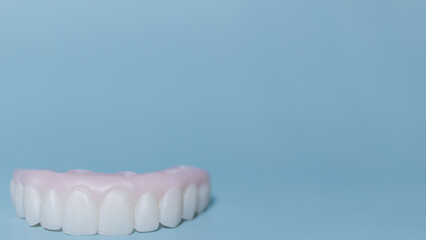 Implant-supported hybrid prosthesis