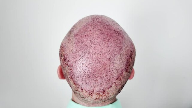 Male fresh post procedure hair transplantation look with a donor and recipient head area.