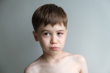 Portrait of angry 6 year boy with red swollen eye isolated on grey background. Serious unhappy face of hooligan after fight with black eye. Bad mood. Alive emotions. Concept of allergic reaction