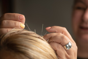 Scalp acupuncture therapy