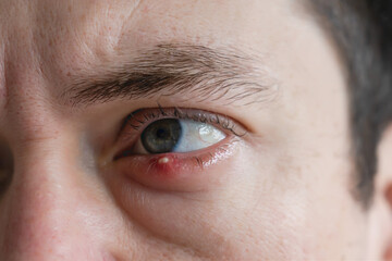 Fototapeta premium Man with infected chalazion (stye, barley) eye on lower eyelid