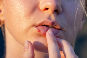 Close up of girl's lips with herpes touching with finger. Beauty dermatology concept