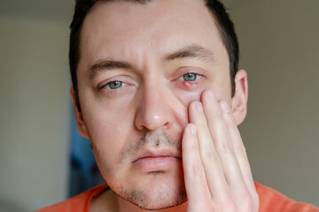 Infected chalazion (stye, barley) or hordeolum eye on lower eyelid of man