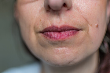 Old scar above lip on face
