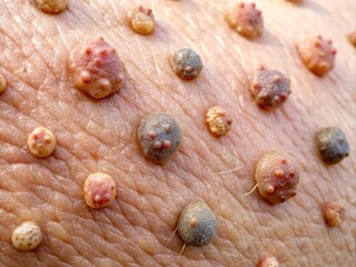 "Close-up photographs of skin tags (acrochordons) on diverse skin tones, showing irregular shapes, soft and flabby appearance, and possible infections or bleeding"