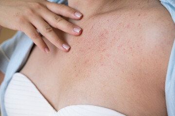 Skin irritation, allergy of a woman, red rash on the skin of the breast. Skin problem, treatment