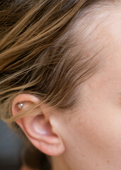 Bald patches on the head of a young woman. Hair loss in the temporal area of the head.