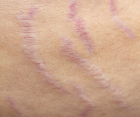 Fototapeta premium A person's arm has a series of purple marks