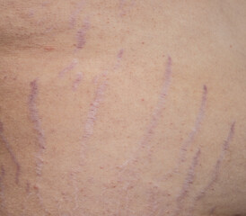 A person's skin is covered in red marks