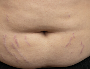 A person's stomach has a few scars on it