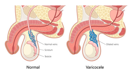 normal veins and varicocele, dilated veins in the scrotum affecting the testicle hand drawn schematic vector illustration. Medical science educational illustration © Oleksandr Pokusai