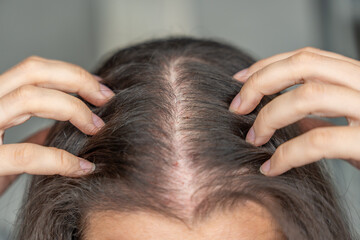 Close-up view of the head with traces of blood from injections after mesotherapy, treatment of...