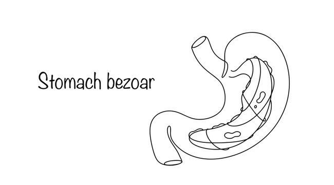 Stomach bezoar