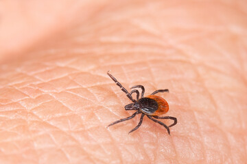 Parasite castor bean, black-legged or deer tick on human skin detail. Ixodes. Parasitic insect mite - bacterial or viral pathogens carrier. Lyme disease or tick-borne encephalitis transmission danger.