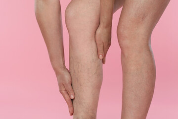 Woman suffering from varicose veins on pink background, closeup