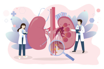 Human kidney Stones Medical Concept. Nephrology vector illustration. The doctor examines and diagnoses urolithiasis disease on a white background.