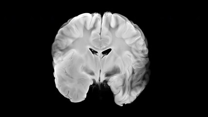 Coronal View of Human Brain with Ischemic Stroke on Transparent Background
