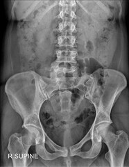 Decoding Abdominal Pathologies: Radiologist’s Approach to KUB X-ray Interpretation